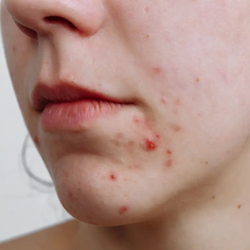 Woman with Acne