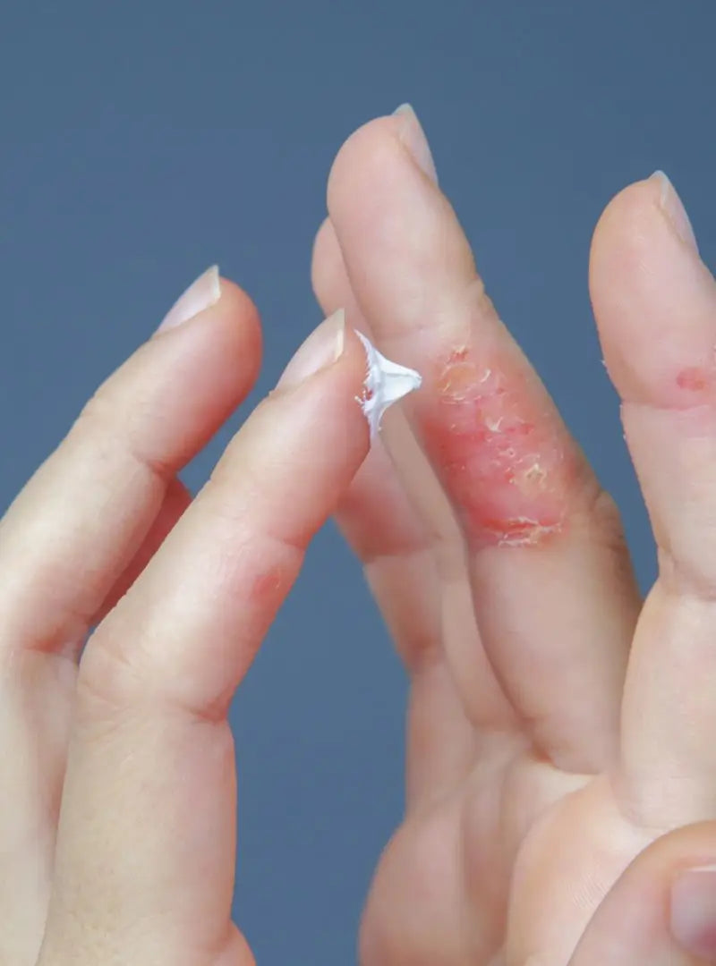 Hand applying cream to a small wound on another finger against a blue background